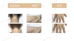 -HEYAN荷妍专业脱毛连锁机构