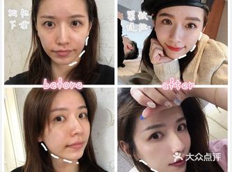 逆龄抗衰，一线之间—线雕