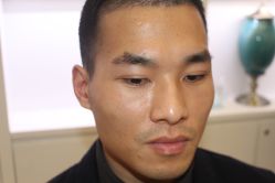 -大麦微针植发丨全国连锁