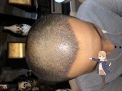 -大麦微针植发丨全国连锁