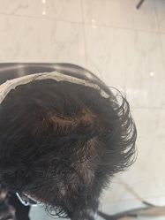 -大麦微针植发丨全国连锁