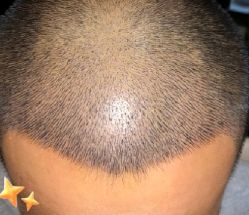 -大麦微针植发丨全国连锁