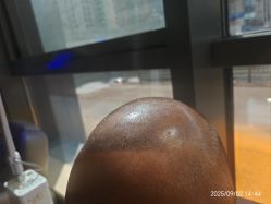 -碧莲盛·不剃发植发