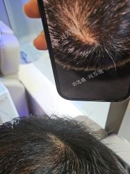 -碧莲盛·不剃发植发