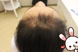 -大麦微针植发丨全国连锁