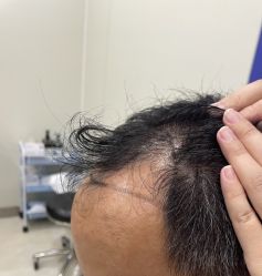 -碧莲盛·不剃发植发