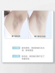 -HEYAN荷妍专业脱毛连锁机构