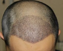 -大麦微针植发丨全国连锁