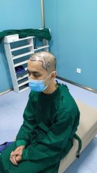 -大麦微针植发全国连锁