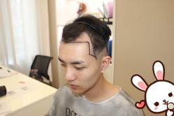 点击看大图 -大麦微针植发丨全国连锁