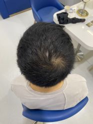 -大麦微针植发全国连锁