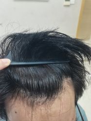 -大麦微针植发丨全国连锁