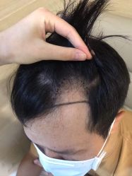 点击看大图 体验前-大麦微针植发丨全国连锁