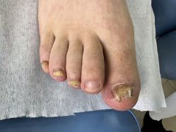 -德哥灰指甲脚气甲沟炎跖疣护理