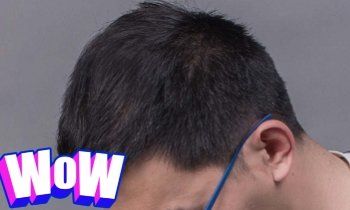 -大麦微针植发丨全国连锁