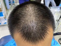 -大麦微针植发全国连锁