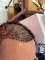 -大麦微针植发丨全国连锁