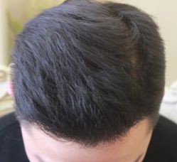 -大麦微针植发丨全国连锁