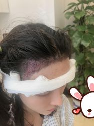 -大麦微针植发丨全国连锁