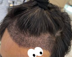 -大麦微针植发全国连锁