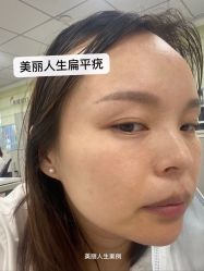 -美丽人生祛斑扁平疣汗管瘤中心