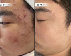 -美肤盾祛痘·问题肌头疗管理中心