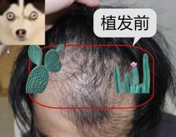 -大麦微针植发全国连锁