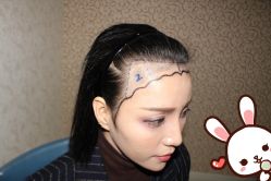 点击看大图 -大麦微针植发丨全国连锁