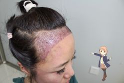 -大麦微针植发丨全国连锁