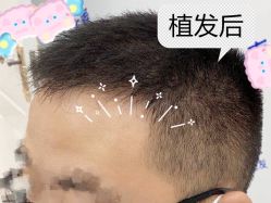 -大麦微针植发全国连锁