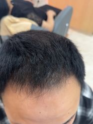 -大麦微针植发丨全国连锁