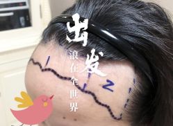 -大麦微针植发全国连锁