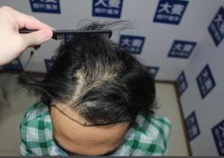 体验前-大麦微针植发丨全国连锁