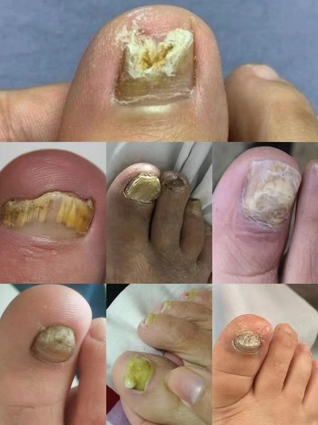 灰指甲又称甲真菌病,新甲连锁店30分钟无