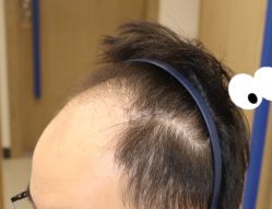 -大麦微针植发全国连锁