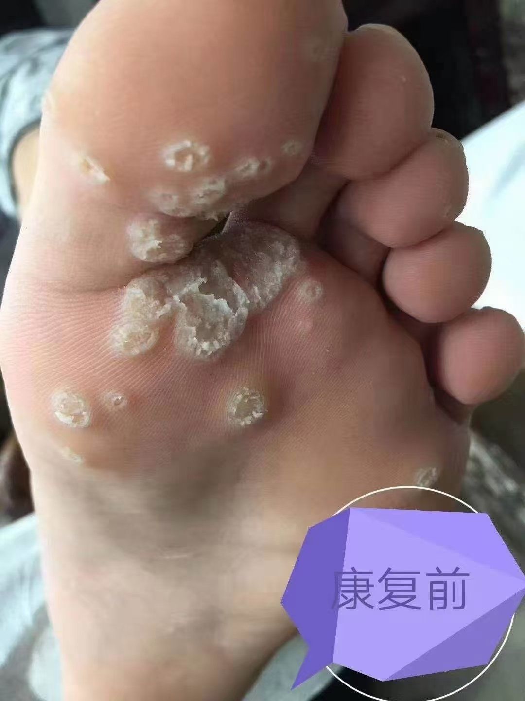 刺猴治疗前后对比