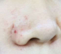 -苗方清颜专业祛痘养生