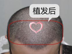 -大麦微针植发丨全国连锁