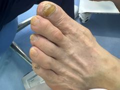 -Andrew指甲专科灰指甲·甲沟炎矫正·3D步态矫形鞋垫定制(浦三路店)