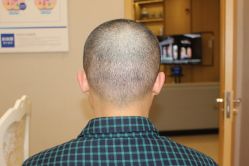 -大麦微针植发丨全国连锁