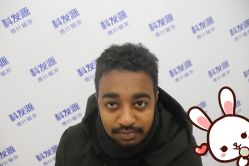 -大麦微针植发丨全国连锁