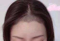 -大麦微针植发丨全国连锁