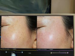 -苑苑vbeauty科技美容SPA