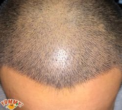 -大麦微针植发丨全国连锁