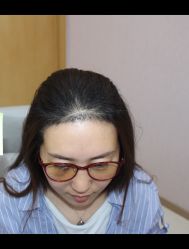 -大麦微针植发全国连锁
