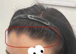 -大麦微针植发全国连锁