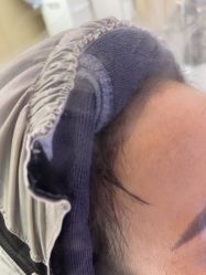 -大麦微针植发丨全国连锁