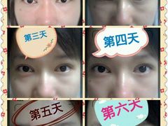 术后六天-上海华安整形外科门诊部