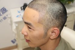 -大麦微针植发丨全国连锁