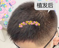 -大麦微针植发全国连锁